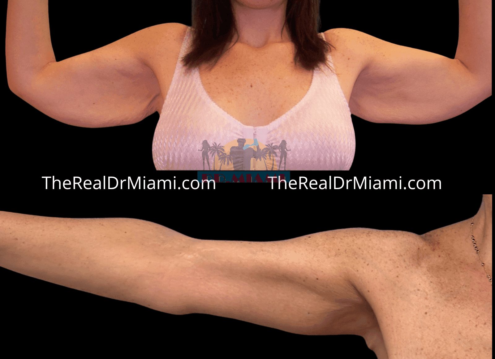 Before-and-after views for Upper Arm Lift, Case 3.