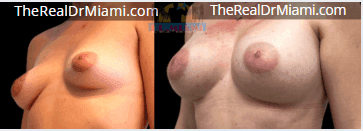 Before-and-after views for Breast Augmentation, Case 14.