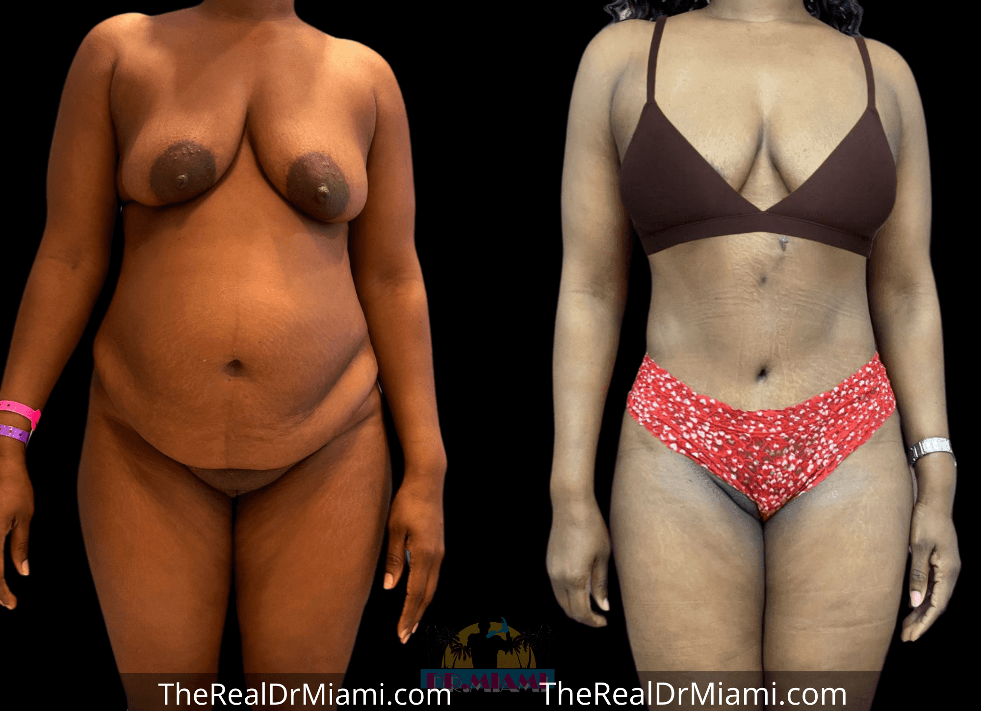 Before-and-after views for Tummy Tuck, Case 14.