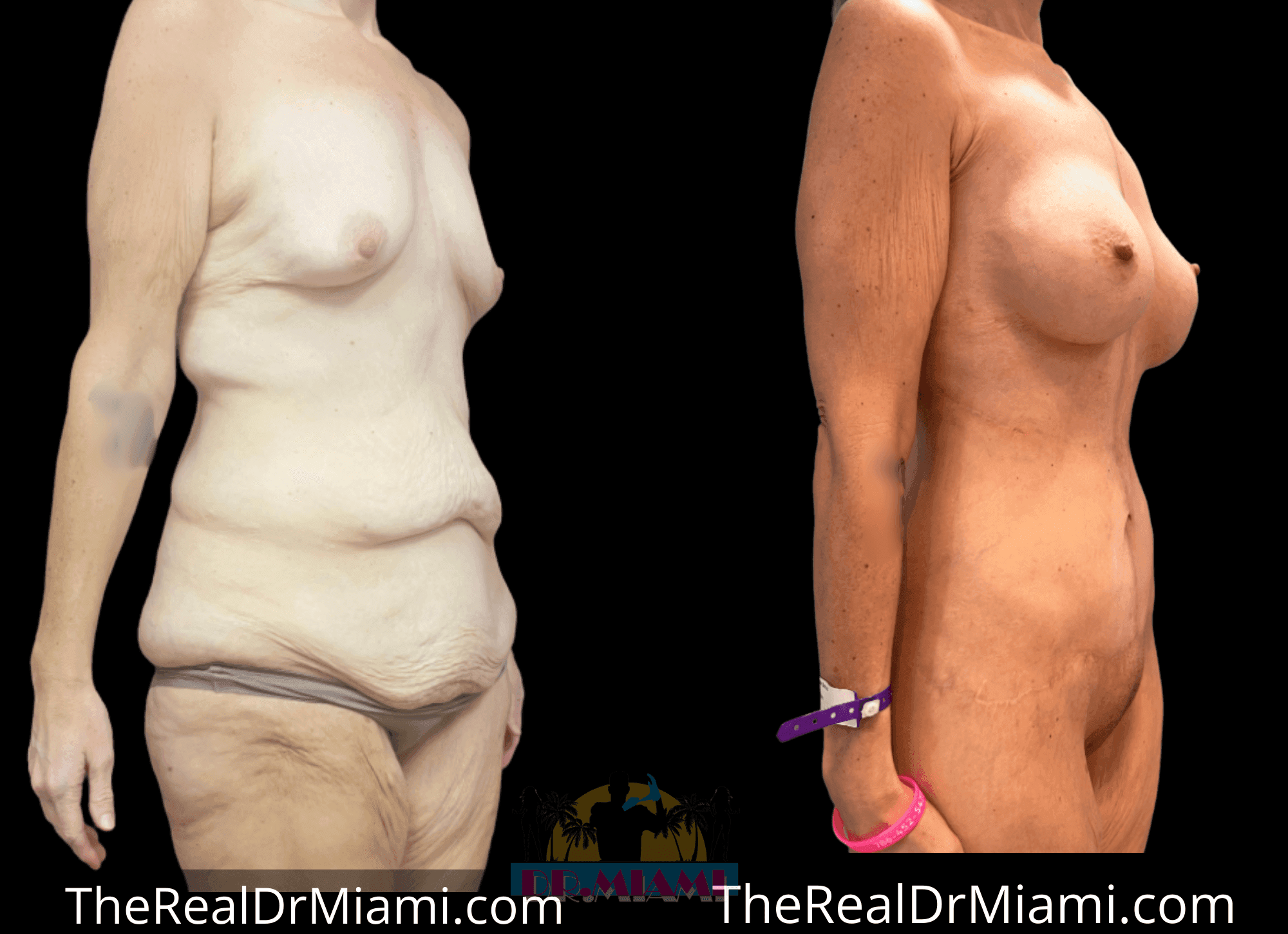 Before-and-after views for Massive Weight Loss, Case 30.