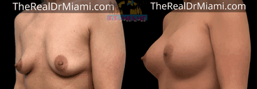 Before-and-after views for Breast Augmentation, Case 69.