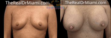 Before-and-after views for Breast Augmentation, Case 73.