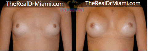 Before-and-after views for Breast Augmentation, Case 118.