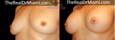 Before-and-after views for Breast Augmentation, Case 115.