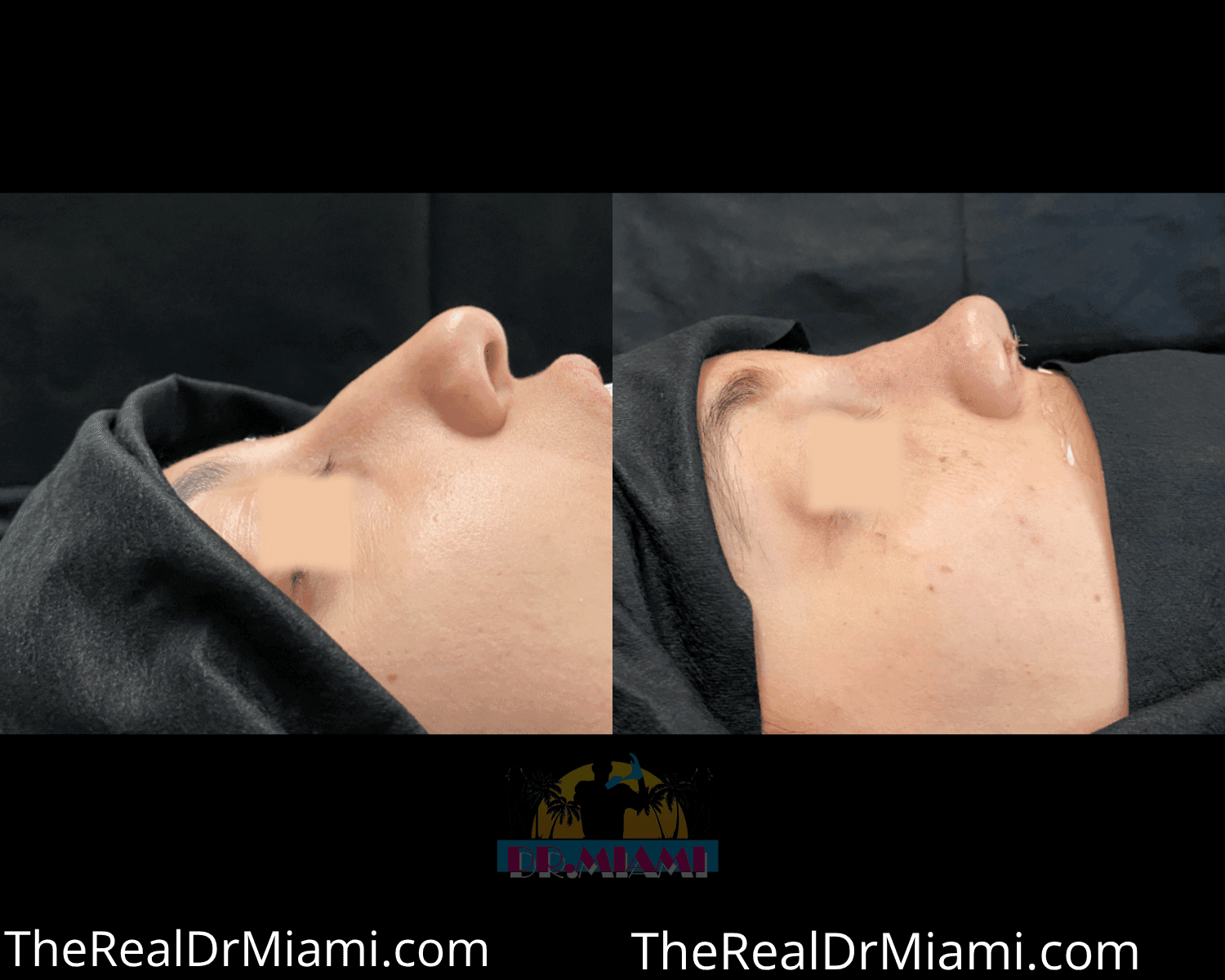 Before-and-after views for Rhinoplasty, Case 35.