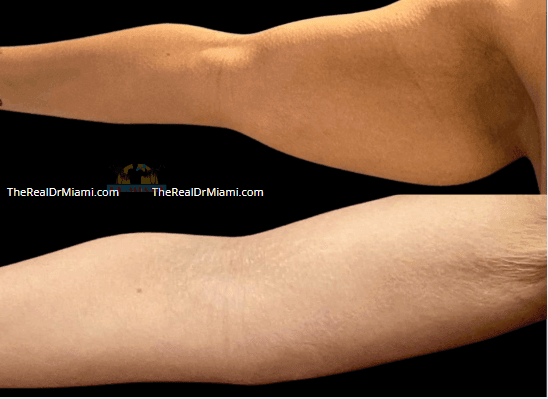 Before-and-after views for Upper Arm Lift, Case 13.