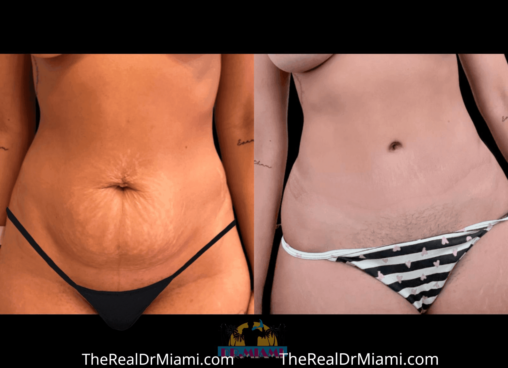 Before-and-after views for Tummy Tuck, Case 21.