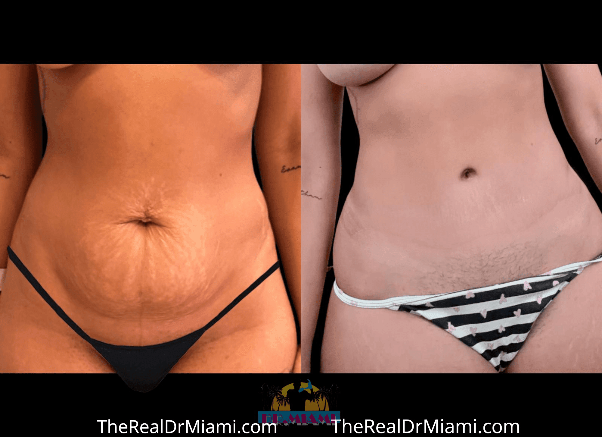 Before-and-after views for Tummy Tuck, Case 21.