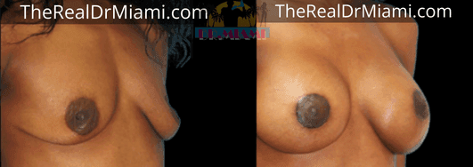 Before-and-after views for Breast Lift, Case 42.