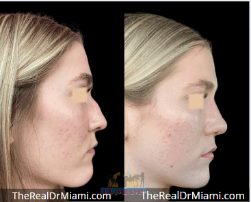Before-and-after views for Rhinoplasty, Case 121.