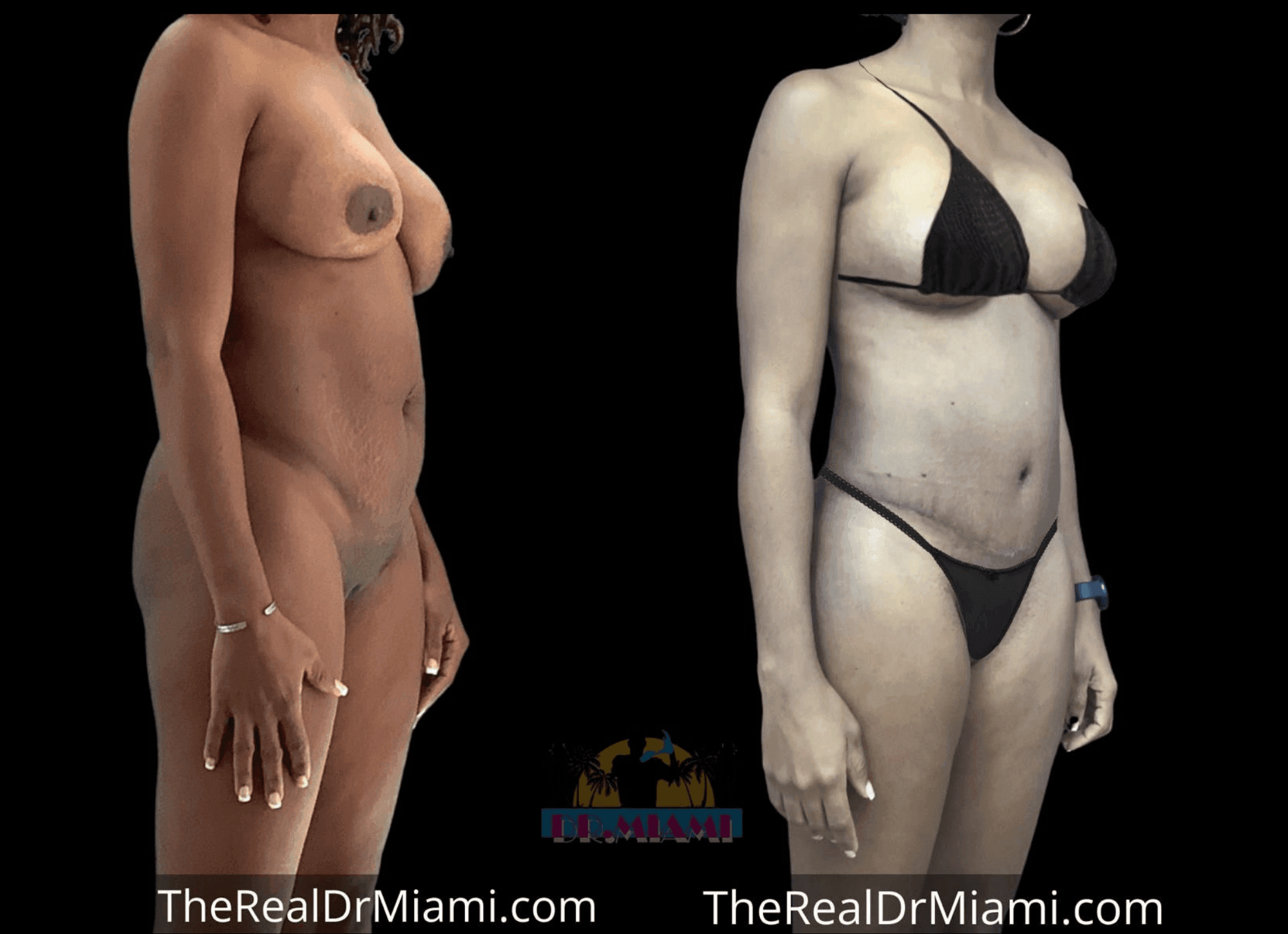 Before-and-after views for Mommy Makeover, Case 61.
