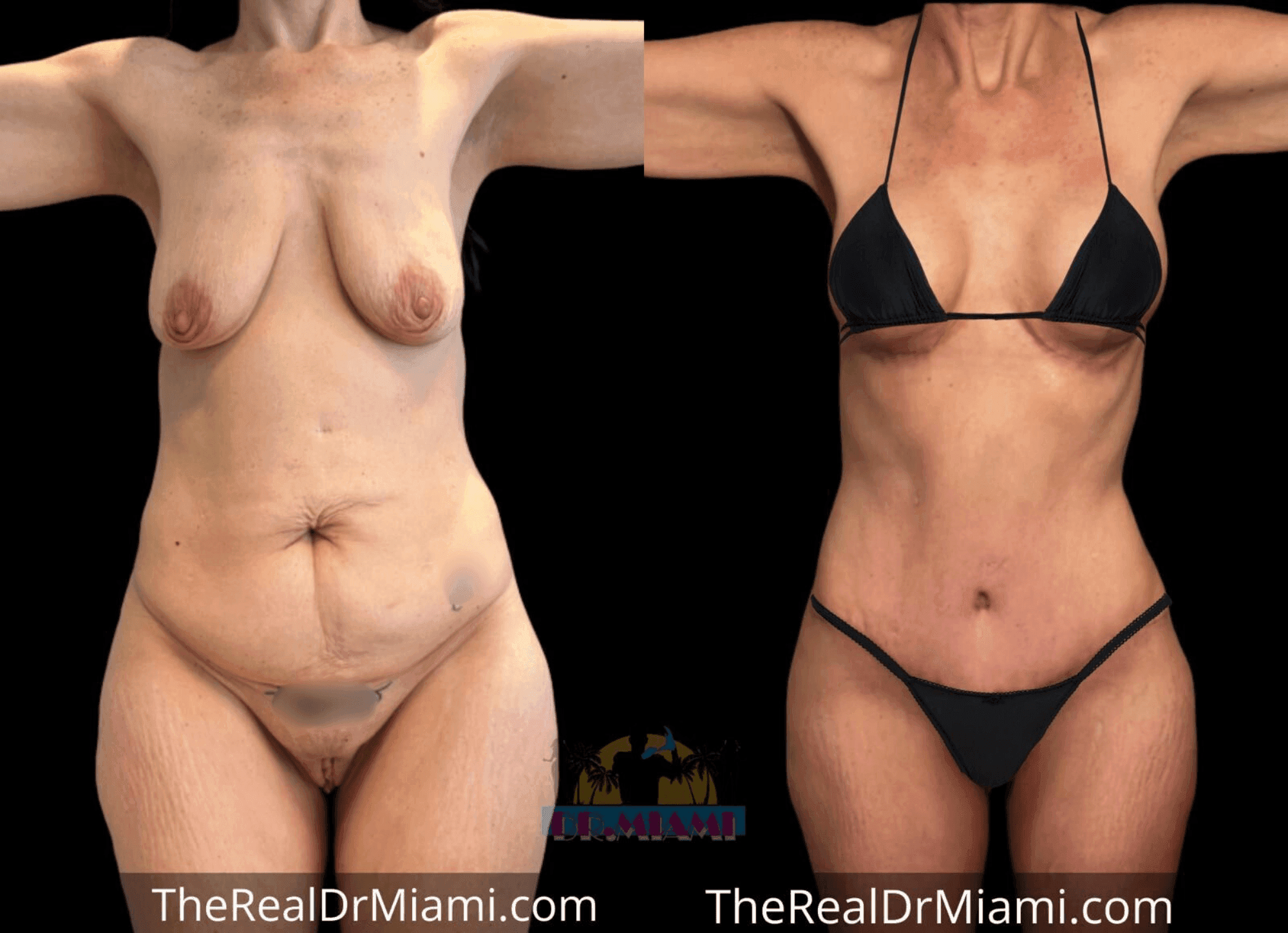 Before-and-after views for Mommy Makeover, Case 46.