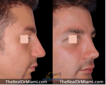 Before-and-after views for Rhinoplasty, Case 100.