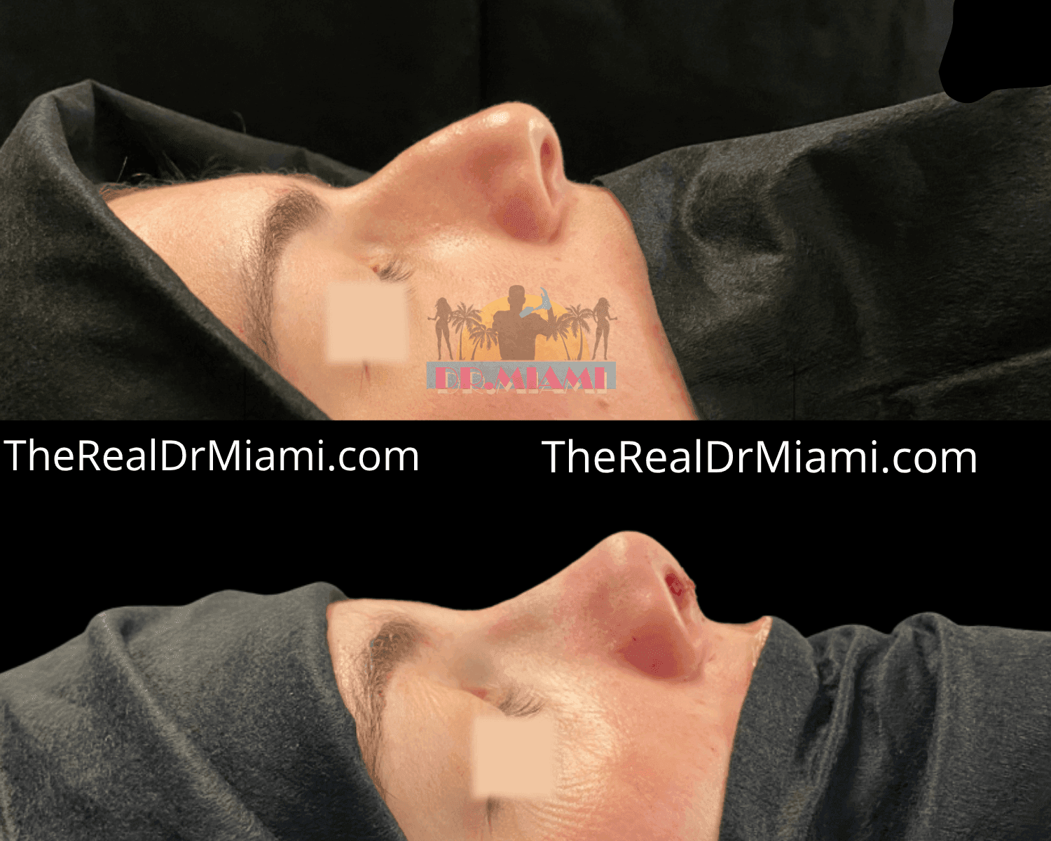 Before-and-after views for Rhinoplasty, Case 32.