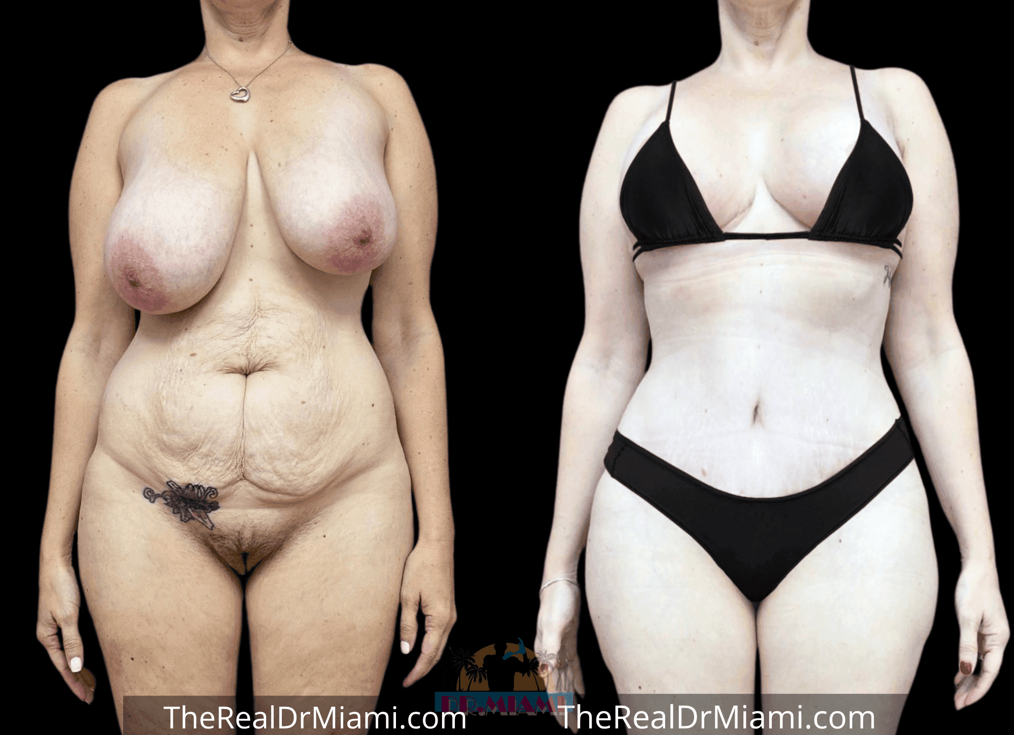 Before-and-after views for Tummy Tuck, Case 7.