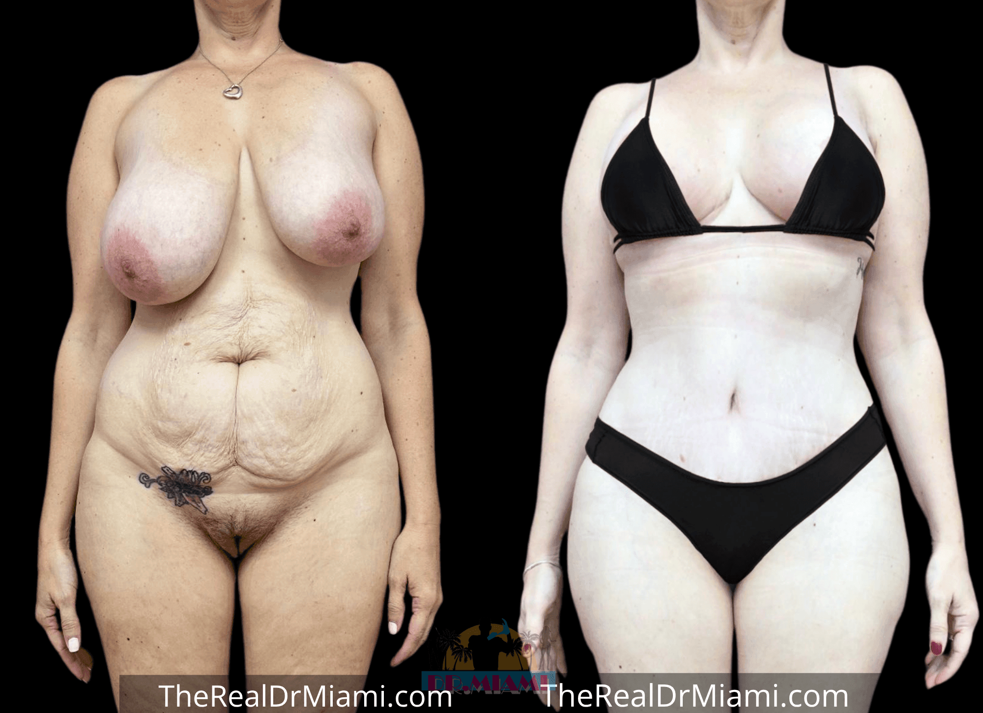 Before-and-after views for Tummy Tuck, Case 7.