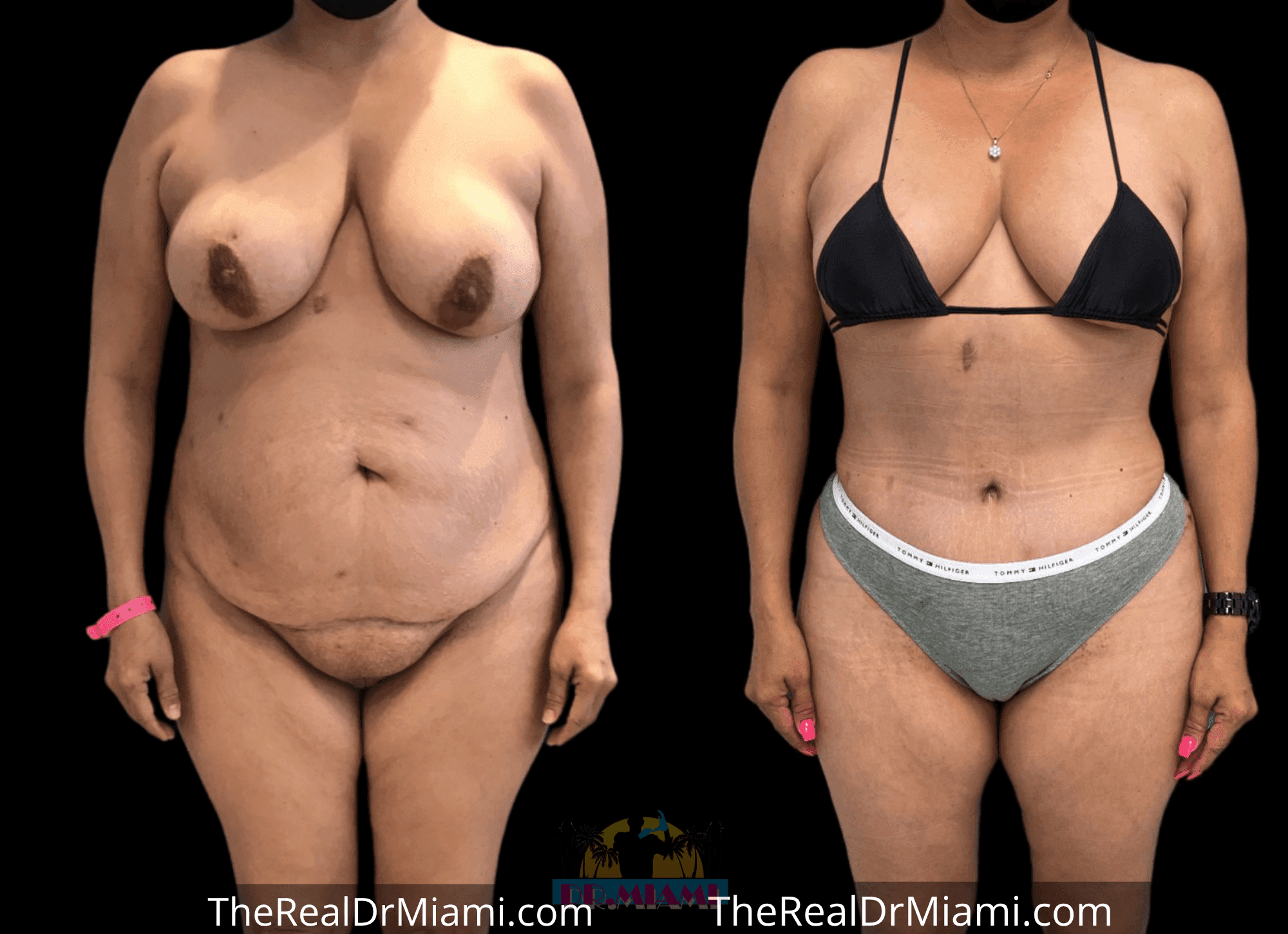 Before-and-after views for Tummy Tuck, Case 48.