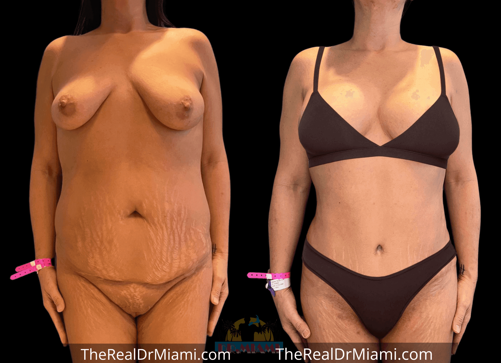 Before-and-after views for Tummy Tuck, Case 57.