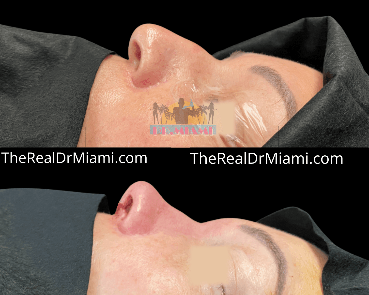 Before-and-after views for Rhinoplasty, Case 15.