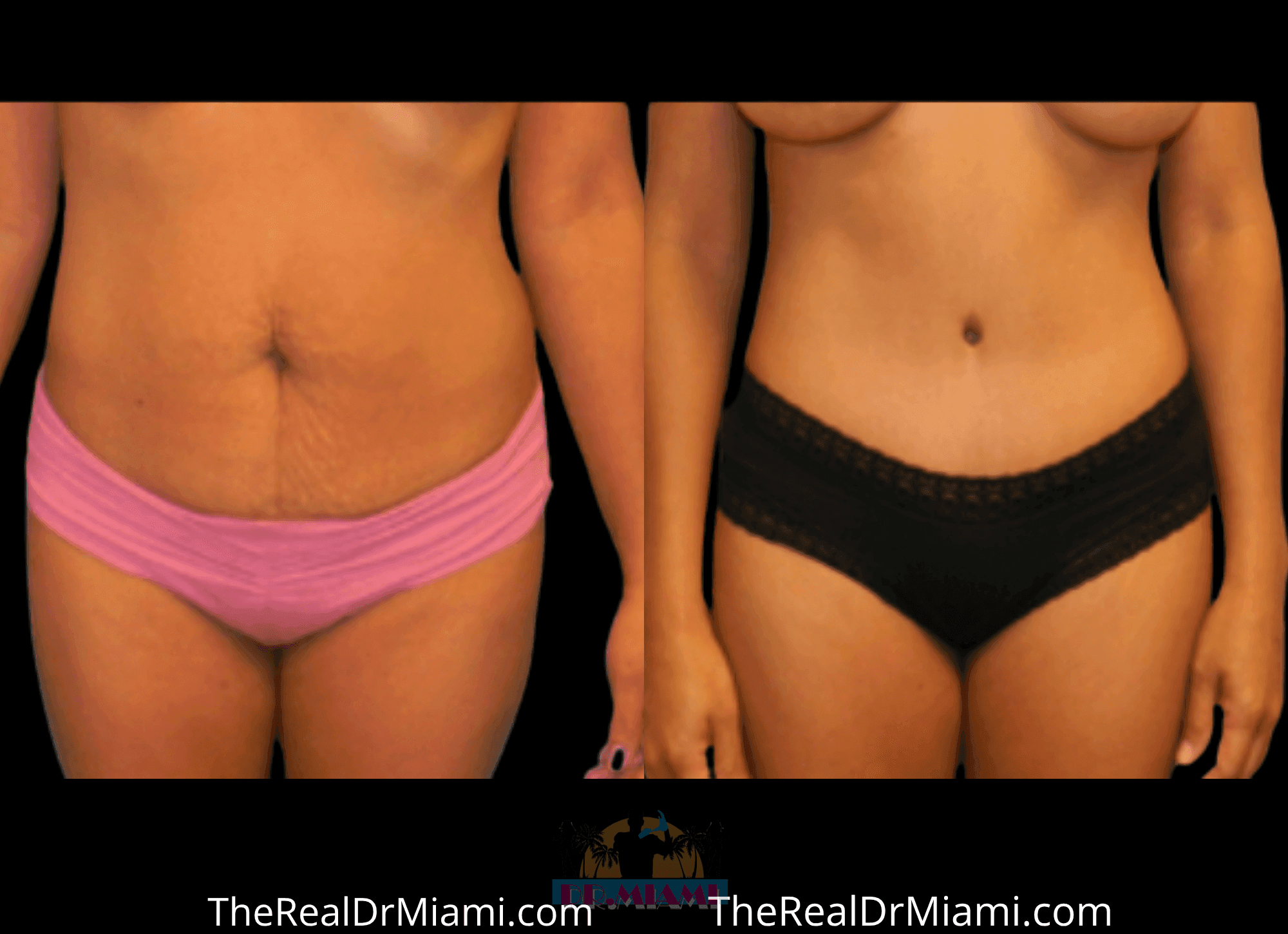 Before-and-after views for Tummy Tuck, Case 89.