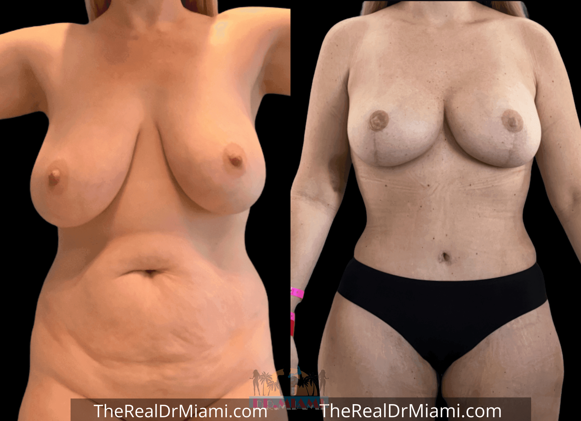 Before-and-after views for Mommy Makeover, Case 11.