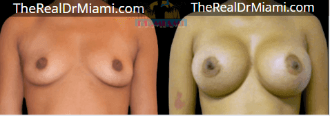 Before-and-after views for Breast Augmentation, Case 100.