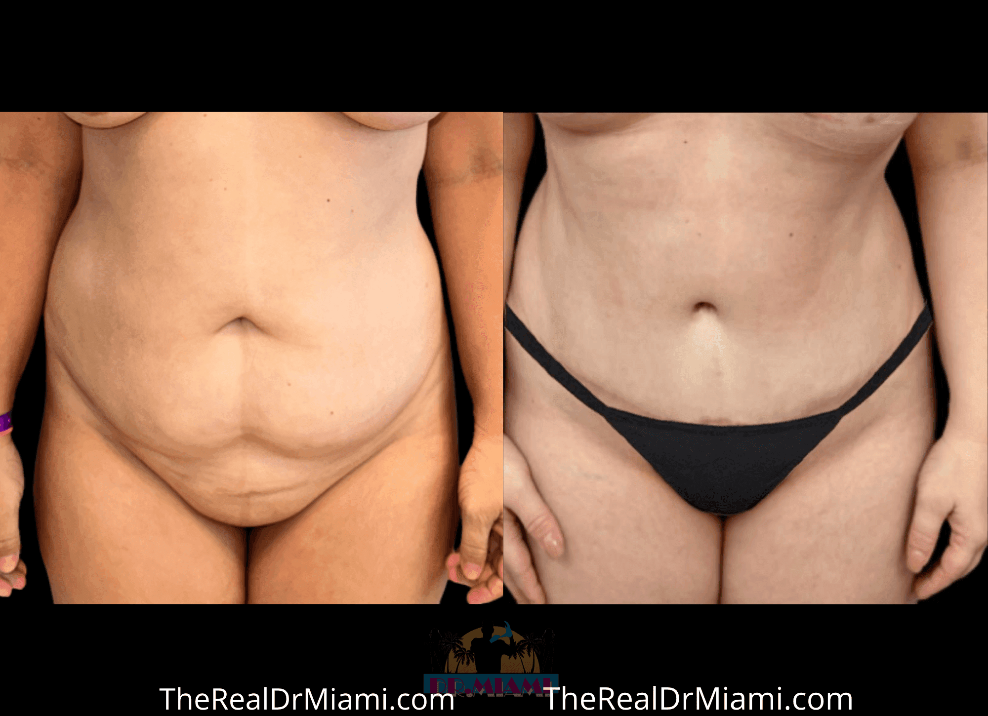 Before-and-after views for Tummy Tuck, Case 15.