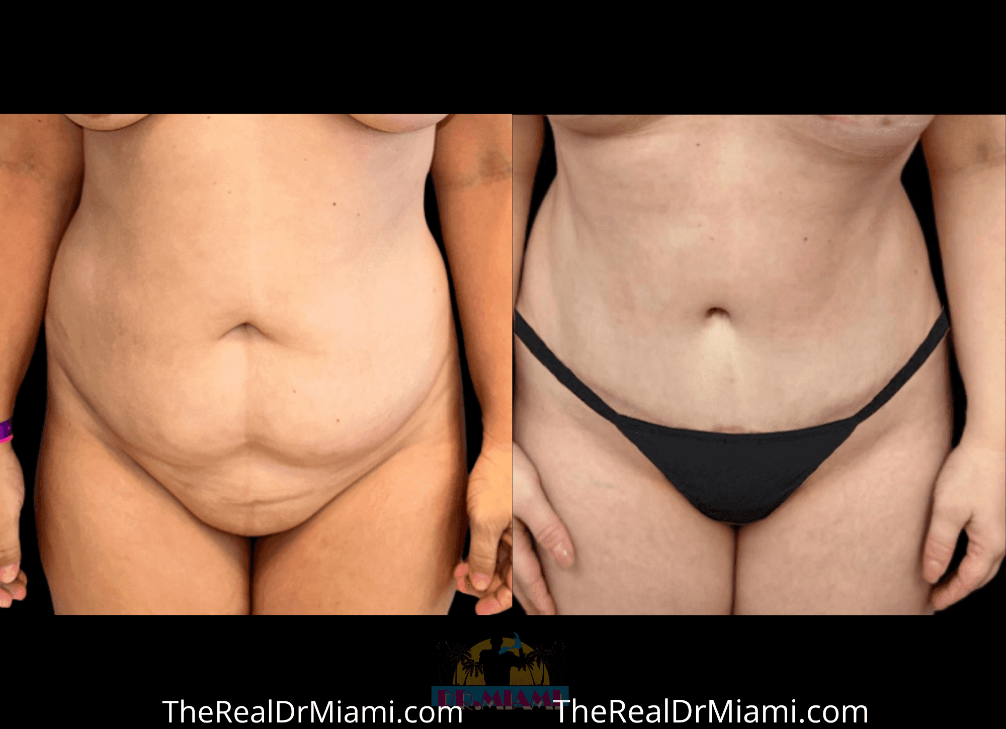 Before-and-after views for Tummy Tuck, Case 15.