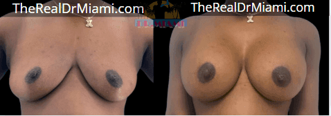 Before-and-after views for Breast Augmentation, Case 127.