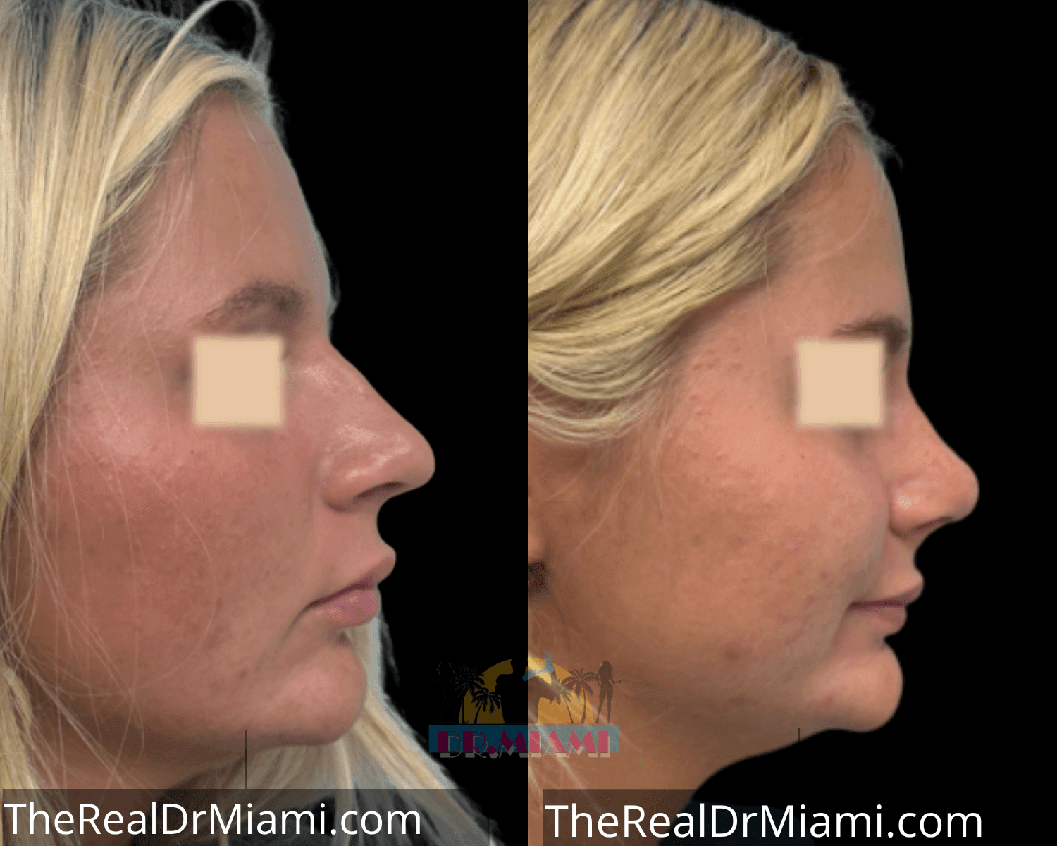 Before-and-after views for Rhinoplasty, Case 24.