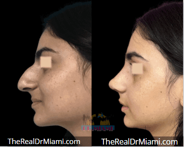 Before-and-after views for Rhinoplasty, Case 129.