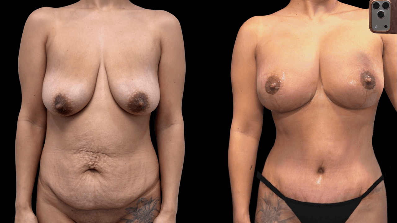 Before-and-after views for Mommy Makeover, Case 1 from The Next Dr. Miami collection.
