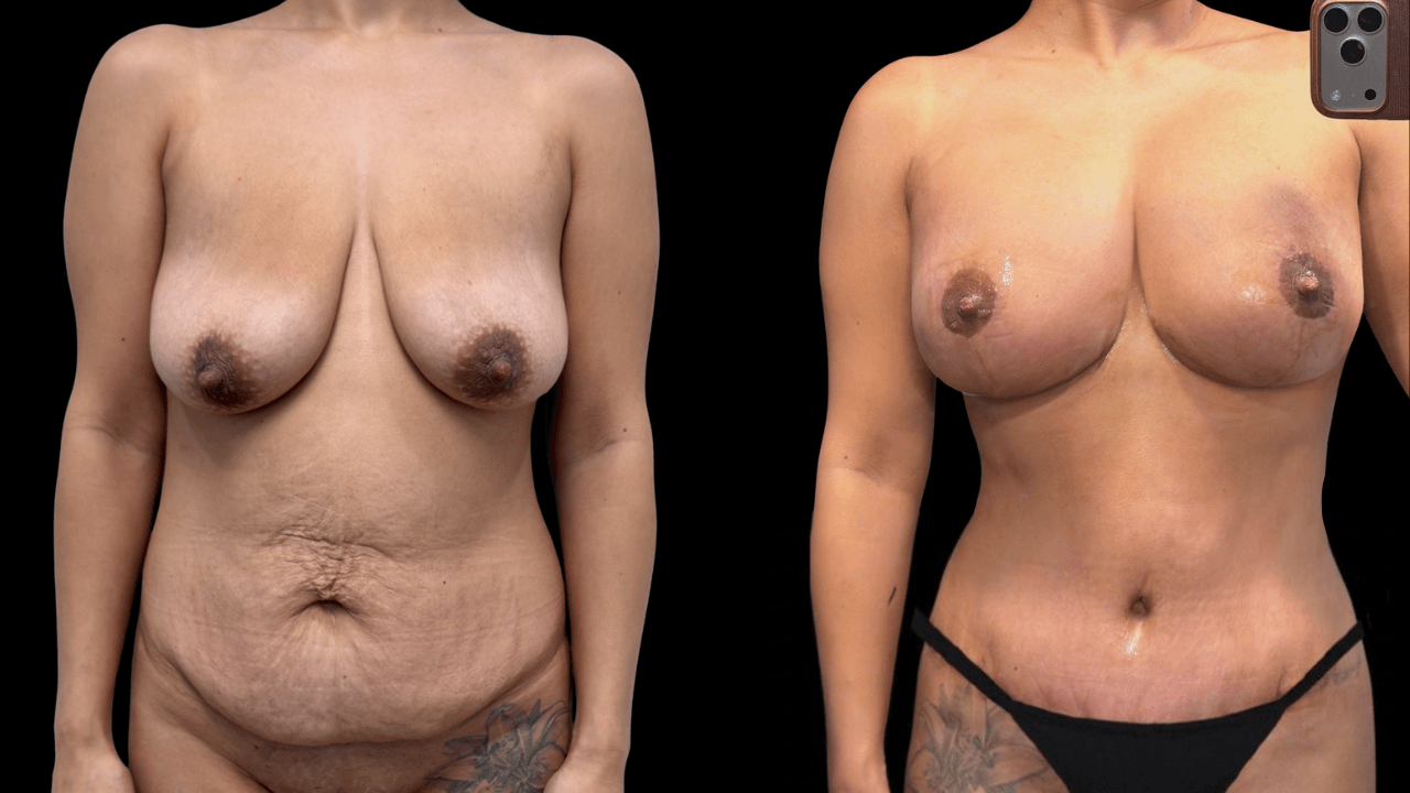 Before-and-after views for Mommy Makeover, Case 1 from The Next Dr. Miami collection.