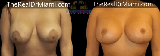 Before-and-after views for Breast Lift, Case 25.