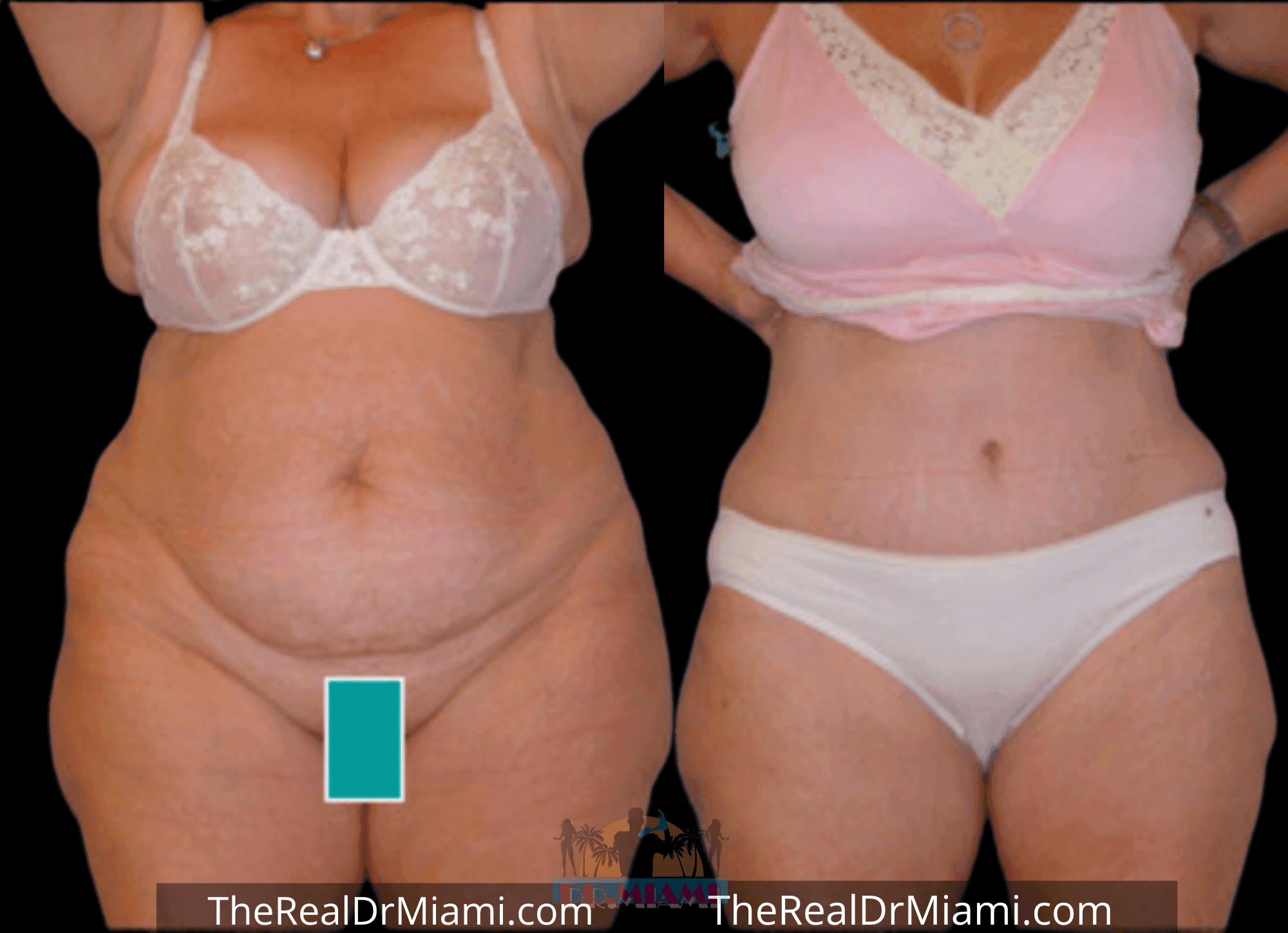 Before-and-after views for Tummy Tuck, Case 70.