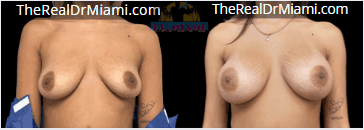 Before-and-after views for Breast Augmentation, Case 36.