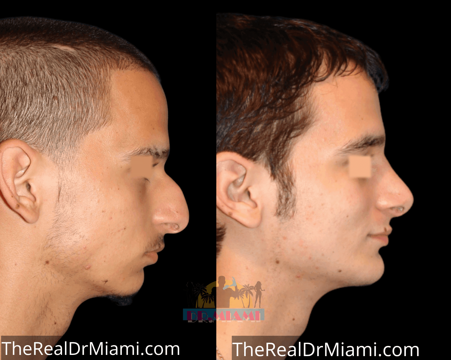 Before-and-after views for Rhinoplasty, Case 30.
