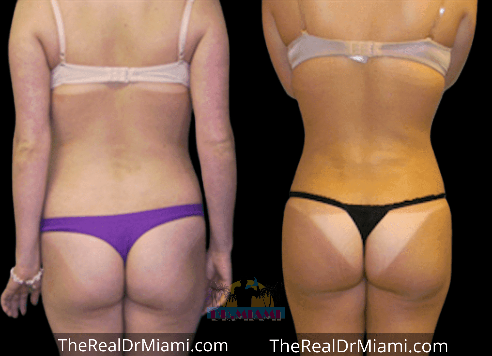 Before-and-after views for Brazilian Butt Lift, Case 92.