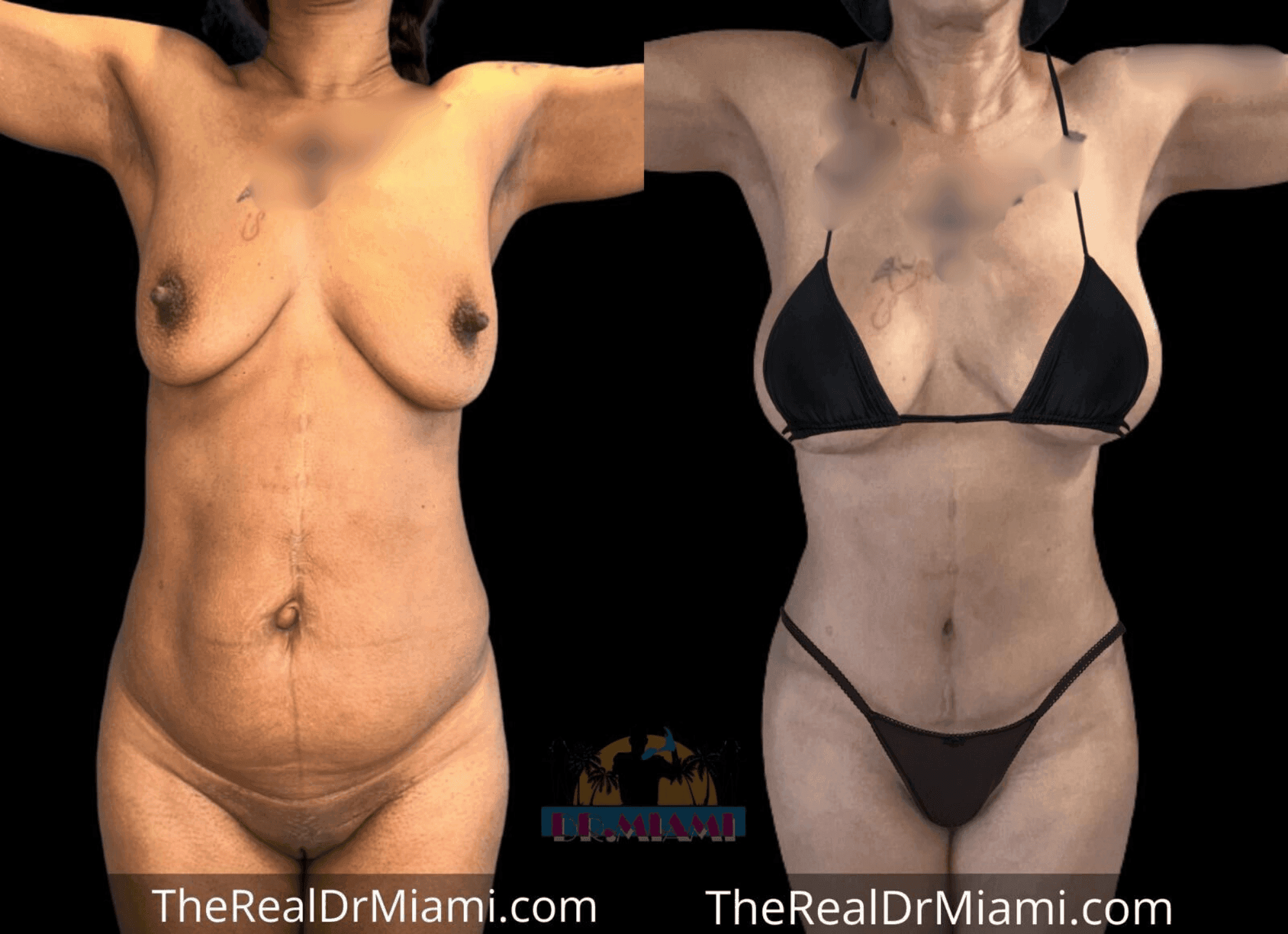 Before-and-after views for Mommy Makeover, Case 60.