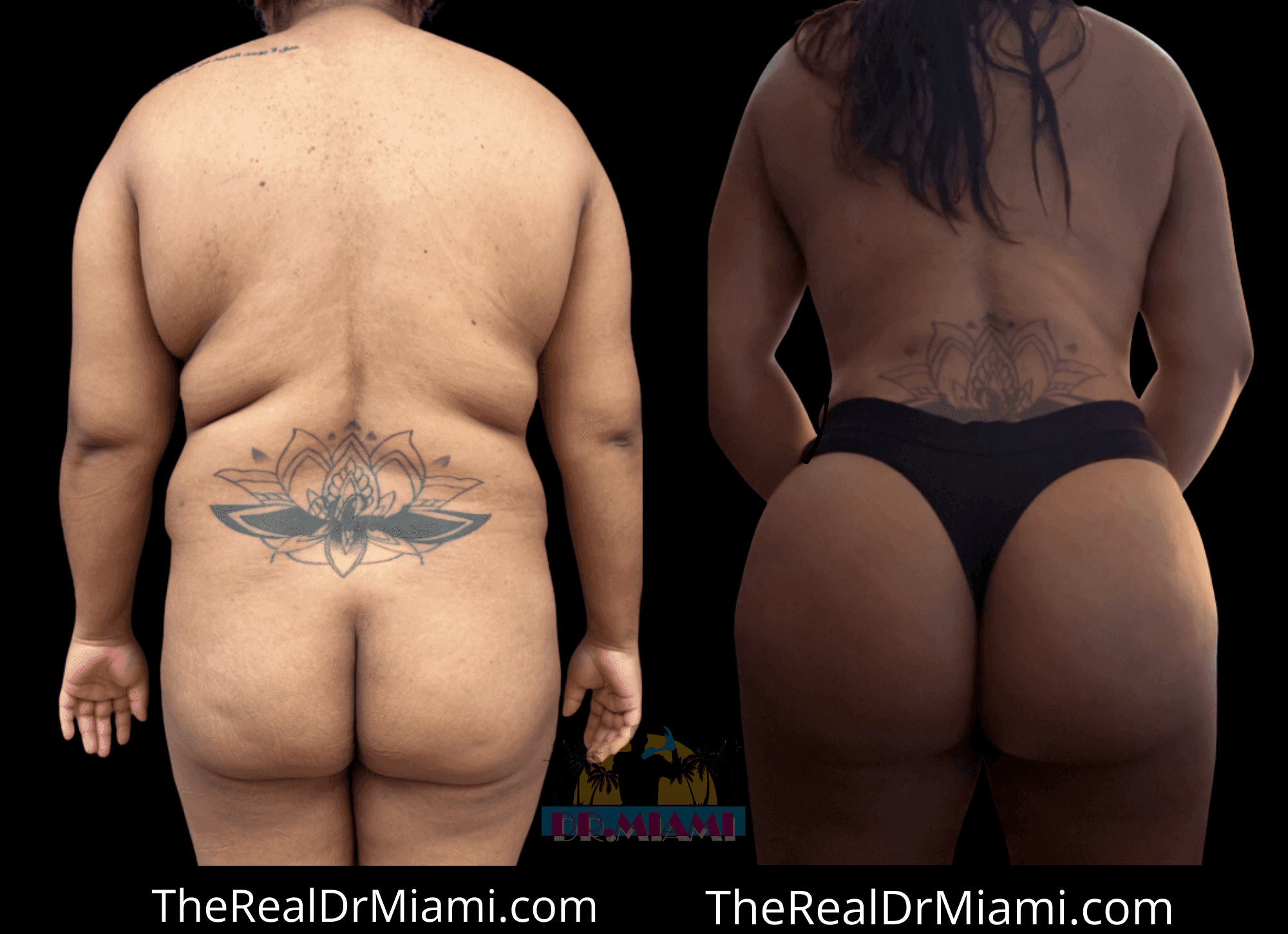 Before-and-after views for Brazilian Butt Lift, Case 118.