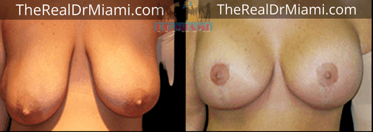 Before-and-after views for Breast Lift, Case 48.