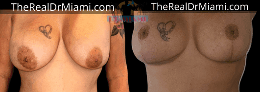 Before-and-after views for Breast Lift, Case 97.