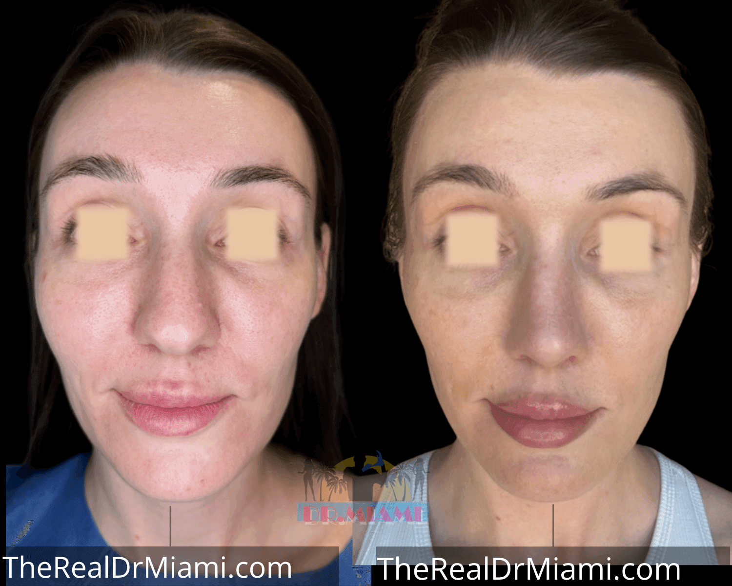 Before-and-after views for Rhinoplasty, Case 14.