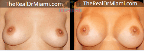 Before-and-after views for Breast Augmentation, Case 114.
