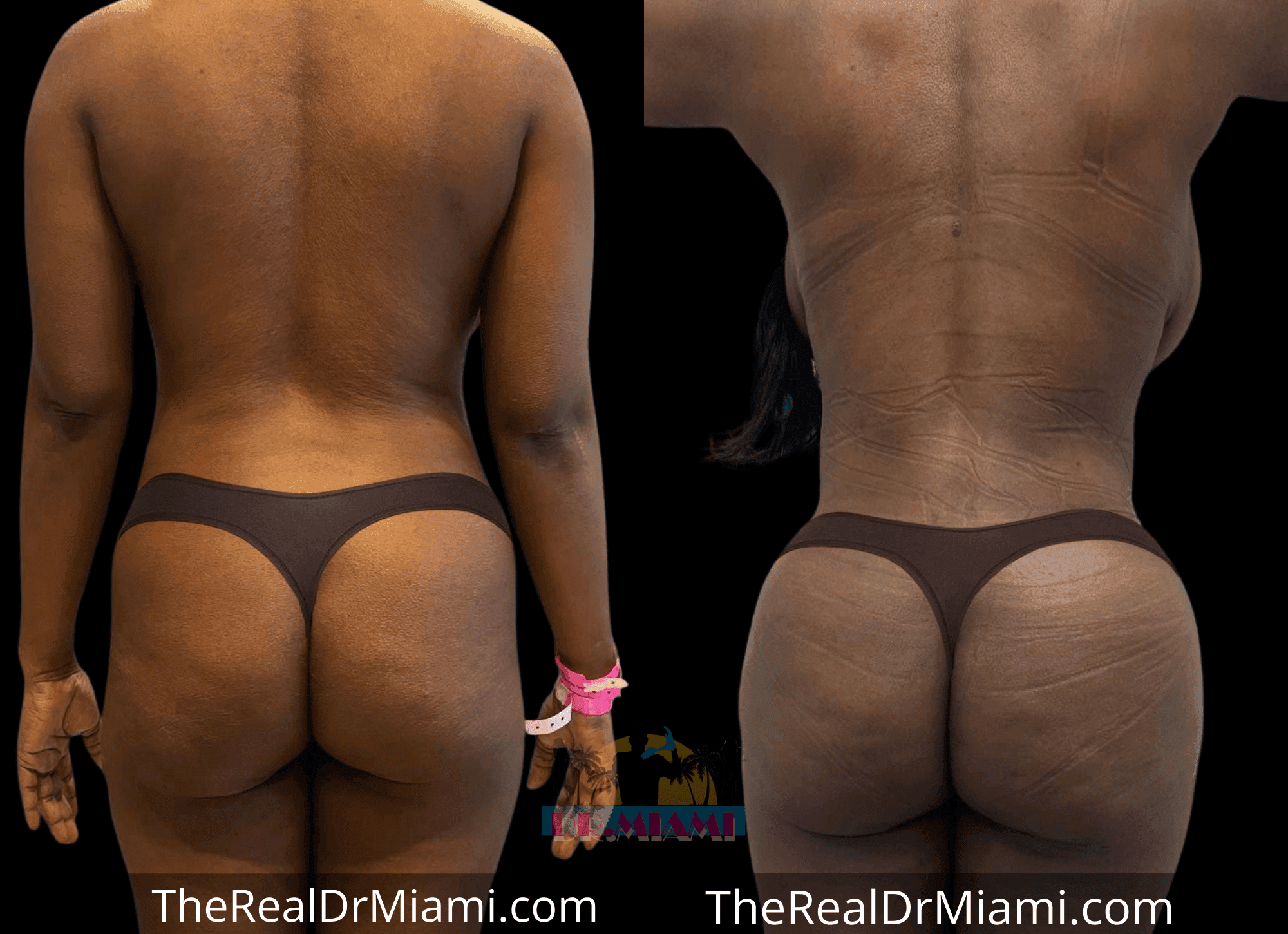 Before-and-after views for Brazilian Butt Lift, Case 78.
