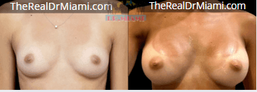 Before-and-after views for Breast Augmentation, Case 22.