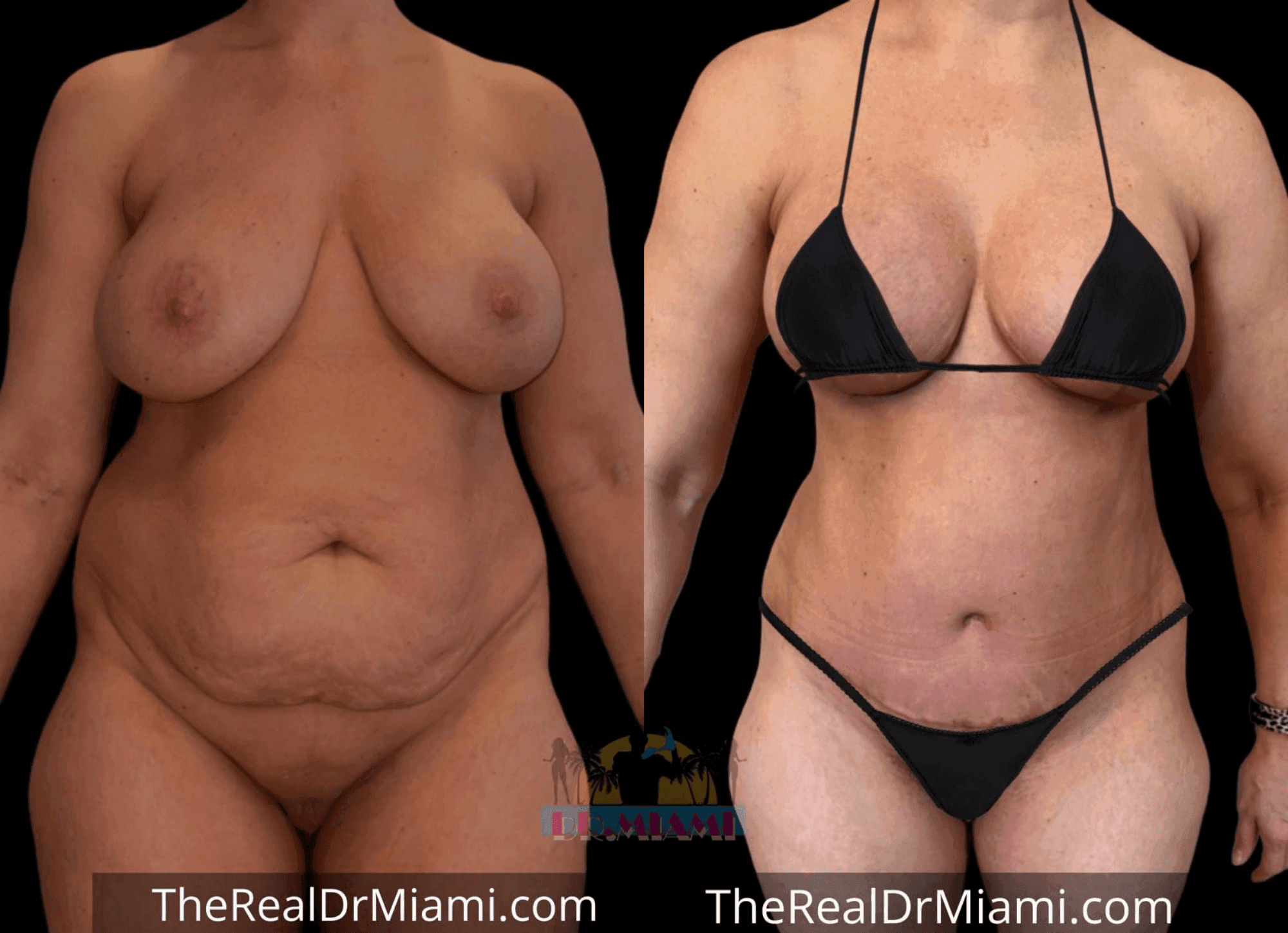Before-and-after views for Mommy Makeover, Case 51.