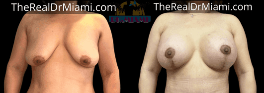 Before-and-after views for Breast Lift, Case 63.