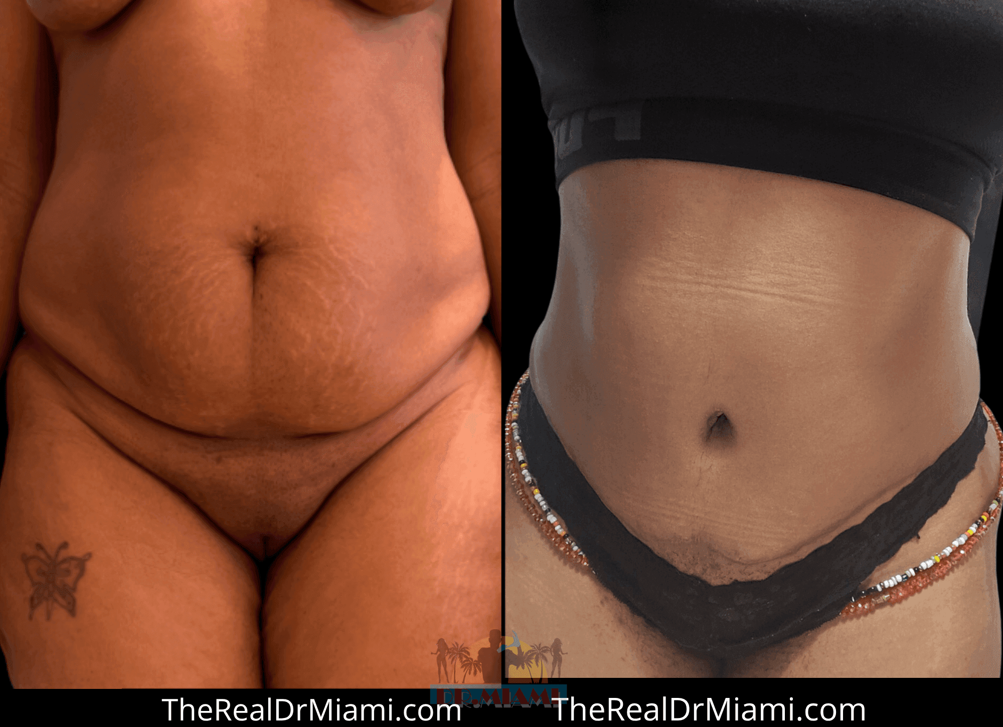 Before-and-after views for Tummy Tuck, Case 32.