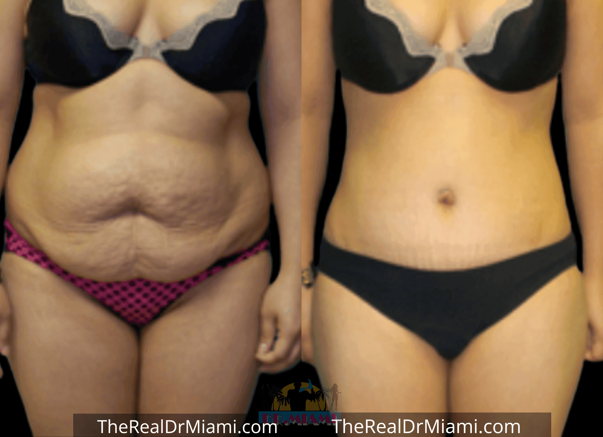 Before-and-after views for Tummy Tuck, Case 76.